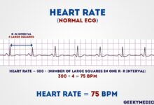 leads ecg placement